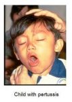 pertussis